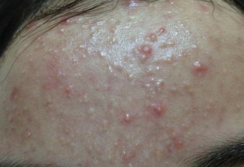 Acne Before Treatment